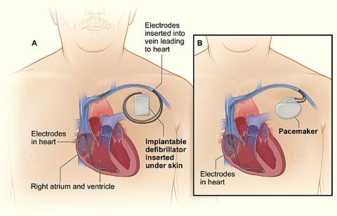 An internal cardiac defibrillator and a pacemaker.