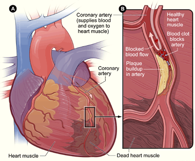Diagram of atherosclerosis showing plaque buildup and blood clot in a coronary artery