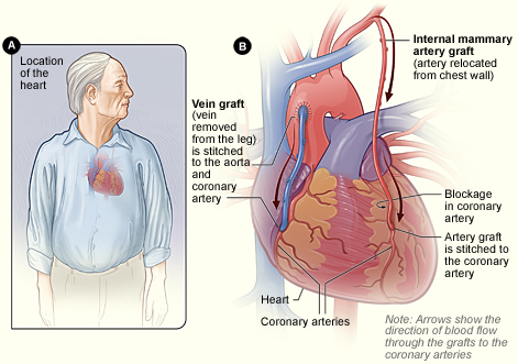 Illustration of a coronary bypass graft