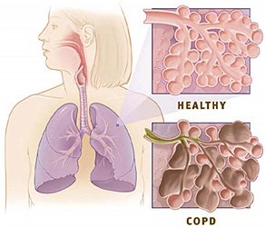 Illustration showing healthy lung alveoli compared with unhealthy alveoli affected by COPD