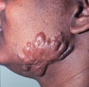 Photograph of a keloid scar