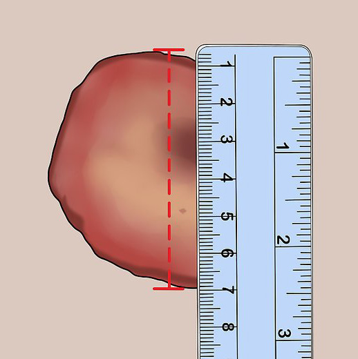  Graphic showing how to measure a wound with a ruler.