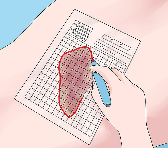Graphic showing how to measure a wound by tracing