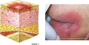Illustration and photo showing a stage 1 pressure injury