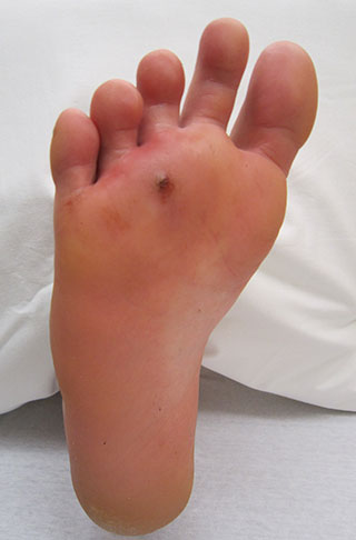 Photograph of a puncture wound in bottom of the foot