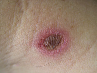 Photograph of a second-degree burn wound