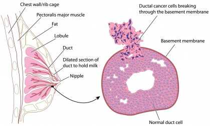 Breast structure, with detail of ductal carcinoma, an invasive type of breast cancer