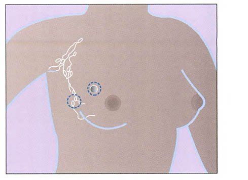 Lumpectomy sites for breast cancer treatment