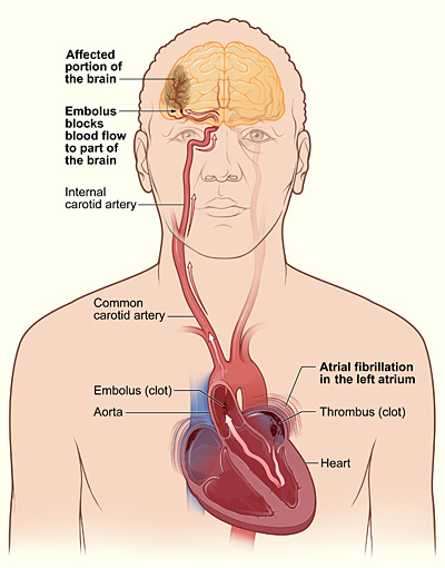 A clot blocks blood flow to the brain in an embolic stroke