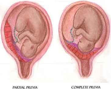 Illustration showing placenta previa pregnancy complication