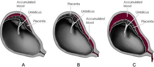 Illustrations showing partial and complete placental abruptions with hemorrhages