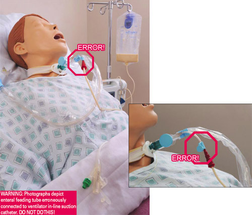 Example of medical error in feeding tube line connection.