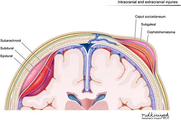 Illustration showing hemorrhages by location within the layers of the meninges.
