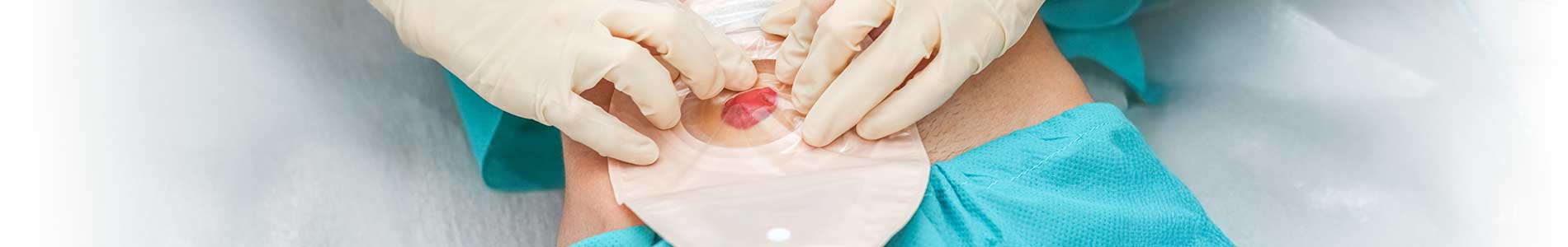 Two hands wearing sterile gloves adjusting a colostomy bag on a patient lying on a bed