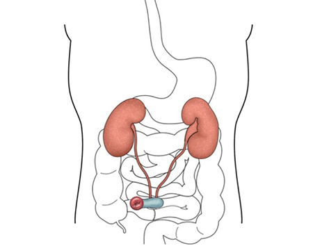 Ileal conduit, showing small piece of bowel used to carry urine