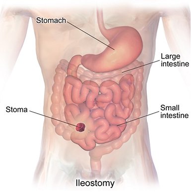 Ileostomy