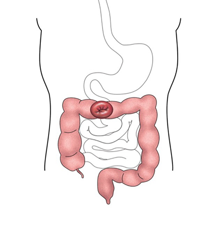 Transverse colostomy