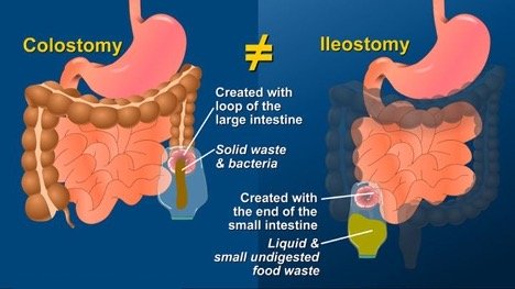 Colostomy vs Ileostomy chart